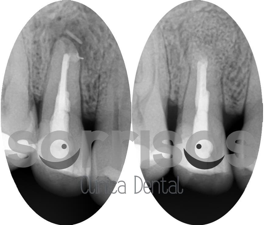 Apicectomía en el tratamiento de la infección dental.