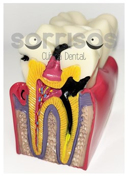 Apicectomía en el tratamiento de la infección dental. - Imagen 5