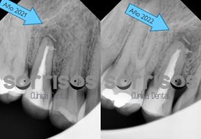 Apicectomía en el tratamiento de la infección dental. - Imagen 6
