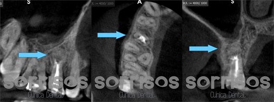 Apicectomía en el tratamiento de la infección dental. - Imagen 3