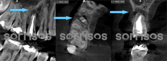 Apicectomía en el tratamiento de la infección dental. - Imagen 2