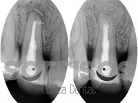 Apicectomía en el tratamiento de la infección dental.
