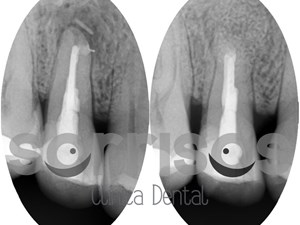 Apicectomía en el tratamiento de la infección dental.