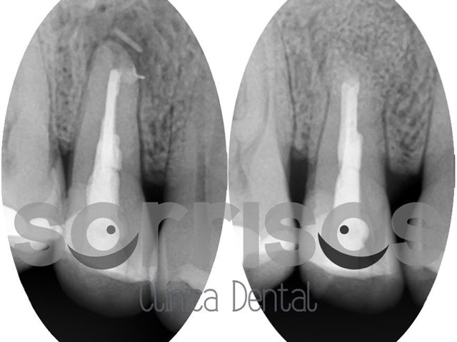 Apicectomía en el tratamiento de la infección dental.