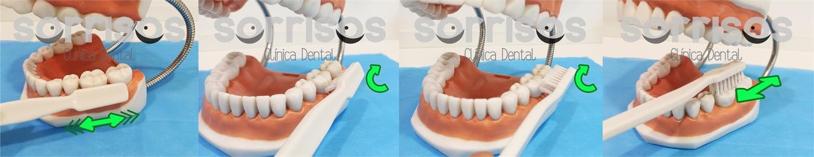 Cepillado dental de dientes naturales y de prótesis fija sobre implantes - Imagen 12