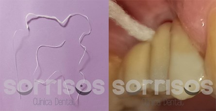 Cepillado dental de dientes naturales y de prótesis fija sobre implantes - Imagen 9