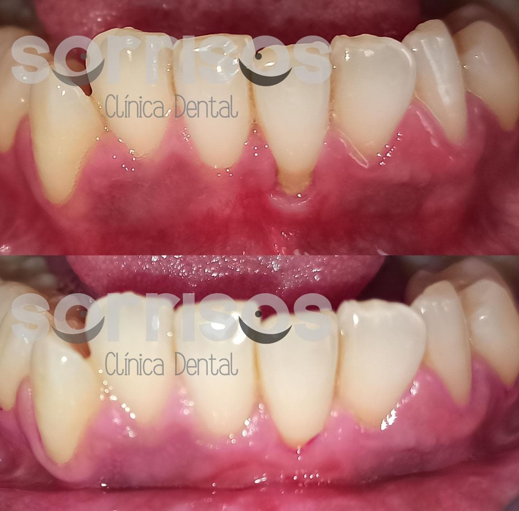 Cobertura de recesión gingival con frenectomía.