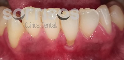 Cobertura de recesión gingival con frenectomía. - Imagen 4