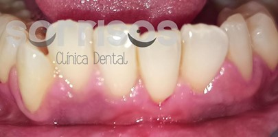 Cobertura de recesión gingival con frenectomía. - Imagen 5