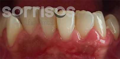 Cobertura de recesión gingival con frenectomía. - Imagen 6