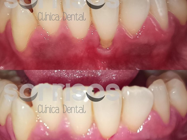 Cobertura de recesión gingival con frenectomía.