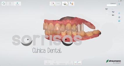 Escáner intraoral, las ventajas de la tecnología digital. - Imagen 4