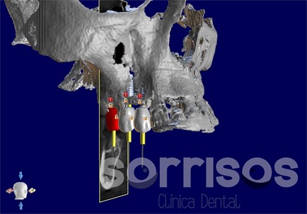 Escáner intraoral, las ventajas de la tecnología digital. - Imagen 6