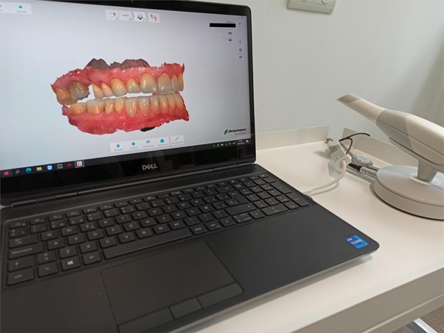 Escáner intraoral, las ventajas de la tecnología digital.