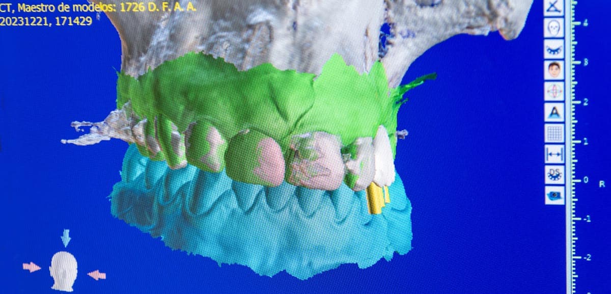 Implantes y prótesis dentales en Pontevedra