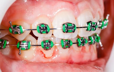 Ortodoncia con brackets en Pontevedra