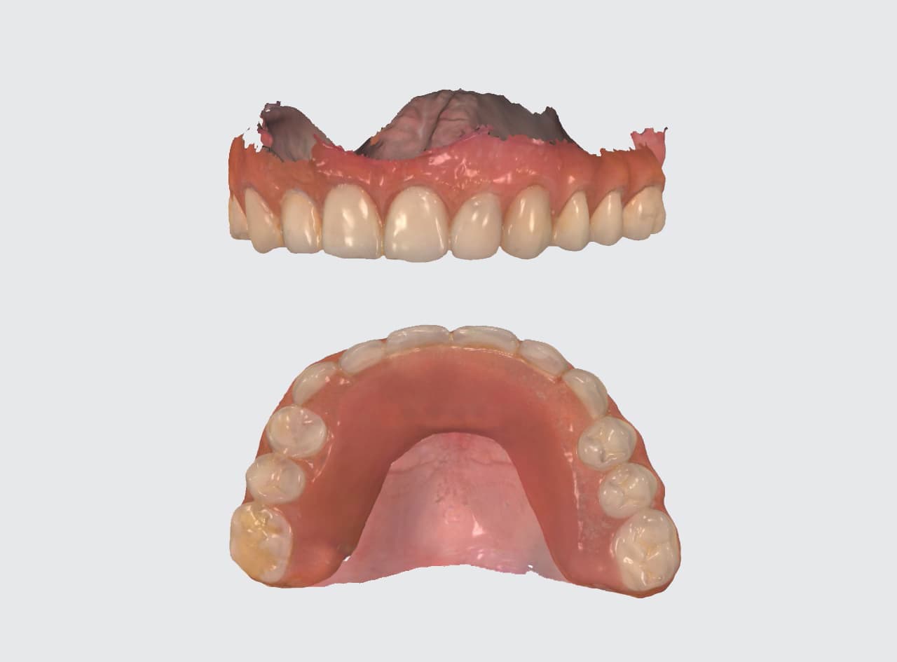 Prótesis dentales removibles en Pontevedra