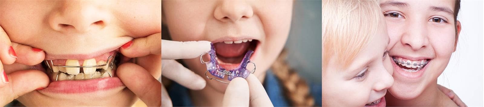 Importancia de la detección temprana de los problemas de ortodoncia en los niños. - Imagen 3