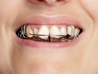 Importancia de la detección temprana de los problemas de ortodoncia en los niños.