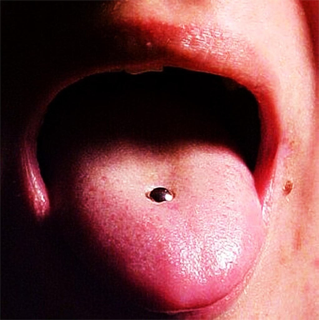 Piercings bucales y ortodoncia