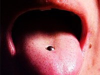 Piercings bucales y ortodoncia