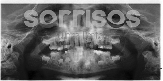 ¿Por qué es importante mantener los dientes de leche? - Imagen 6