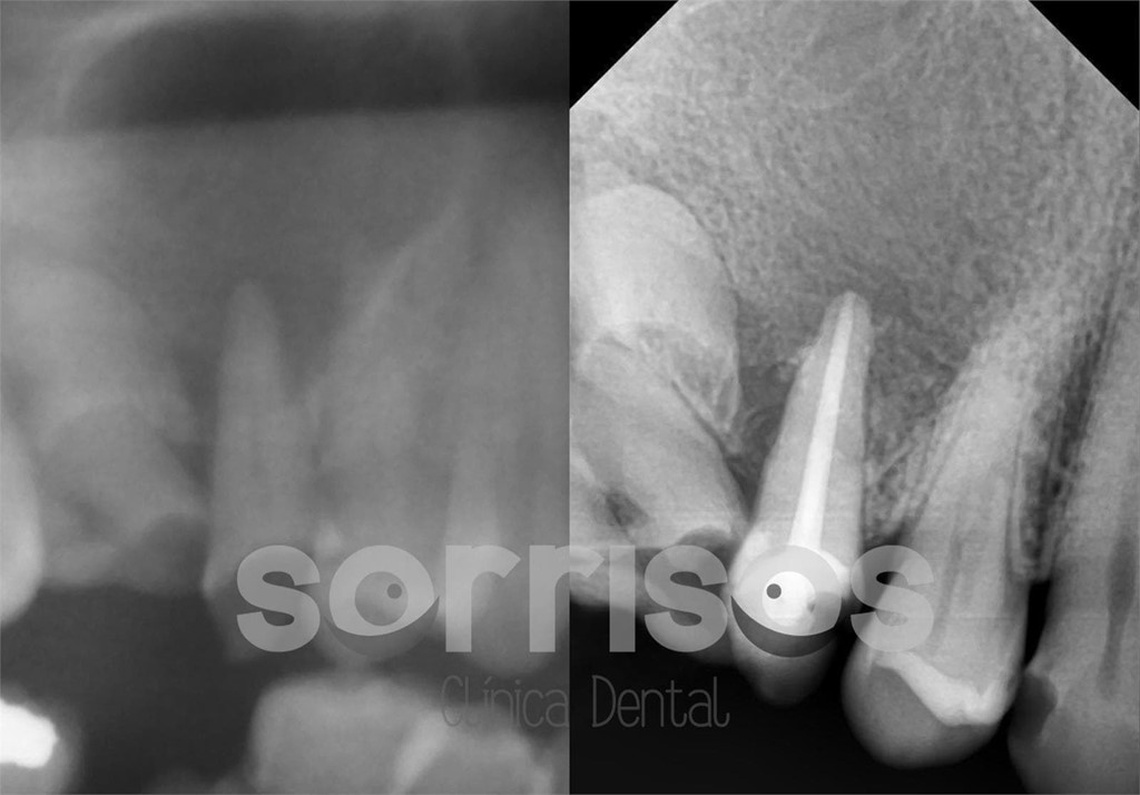 Regeneración ósea y endodoncia