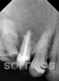 Regeneración ósea y endodoncia - Imagen 27