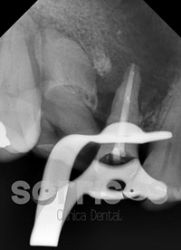 Regeneración ósea y endodoncia - Imagen 26