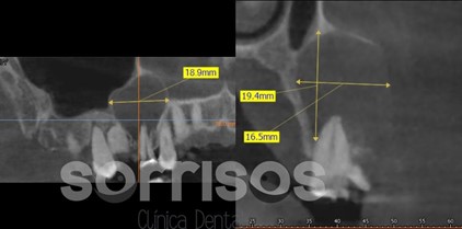 Regeneración ósea y endodoncia - Imagen 18