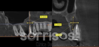 Regeneración ósea y endodoncia - Imagen 19