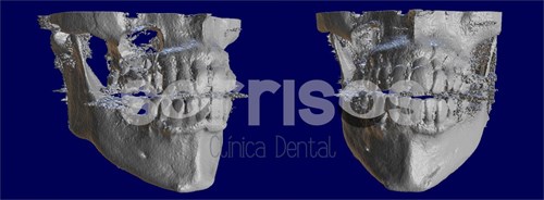 Regeneración ósea y endodoncia - Imagen 15
