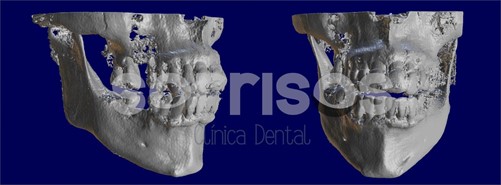 Regeneración ósea y endodoncia - Imagen 16