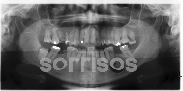 Regeneración ósea y endodoncia - Imagen 28