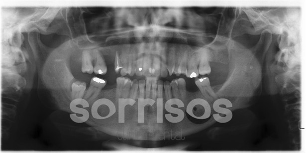 Regeneración ósea y endodoncia - Imagen 30