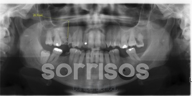 Regeneración ósea y endodoncia - Imagen 25