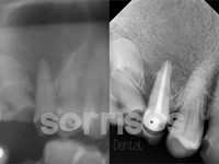 Regeneración ósea y endodoncia