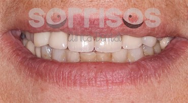 Rehabilitación de dientes desgastados - Imagen 8