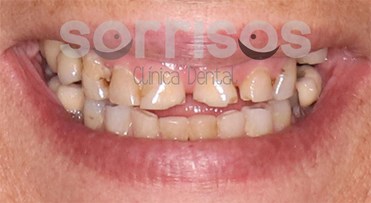 Rehabilitación de dientes desgastados - Imagen 7