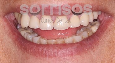 Rehabilitación de dientes desgastados - Imagen 9