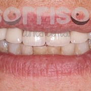 Rehabilitación de dientes desgastados