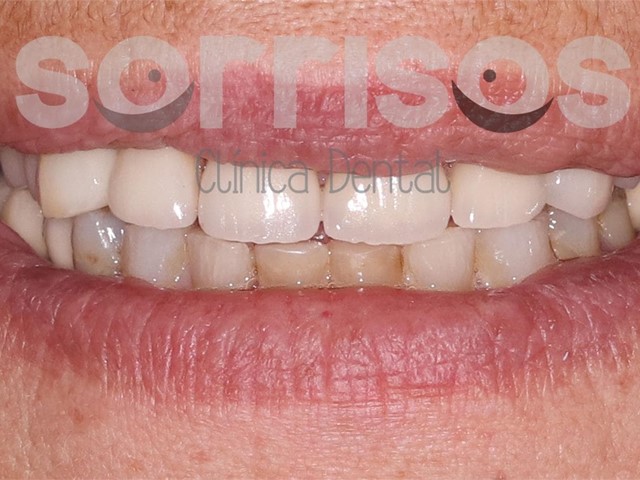 Rehabilitación de dientes desgastados