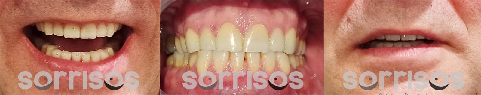 Rehabilitación de grandes desgastes dentarios - Imagen 17