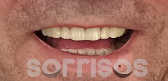 Rehabilitación de grandes desgastes dentarios - Imagen 18