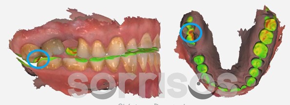 Rehabilitación de grandes desgastes dentarios - Imagen 19