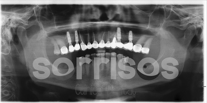 Rehabilitación multidisciplinar mediante implantes con elevación de seno maxilar - Imagen 12