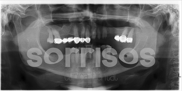 Rehabilitación multidisciplinar mediante implantes con elevación de seno maxilar - Imagen 14