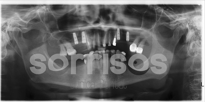 Rehabilitación multidisciplinar mediante implantes con elevación de seno maxilar - Imagen 8