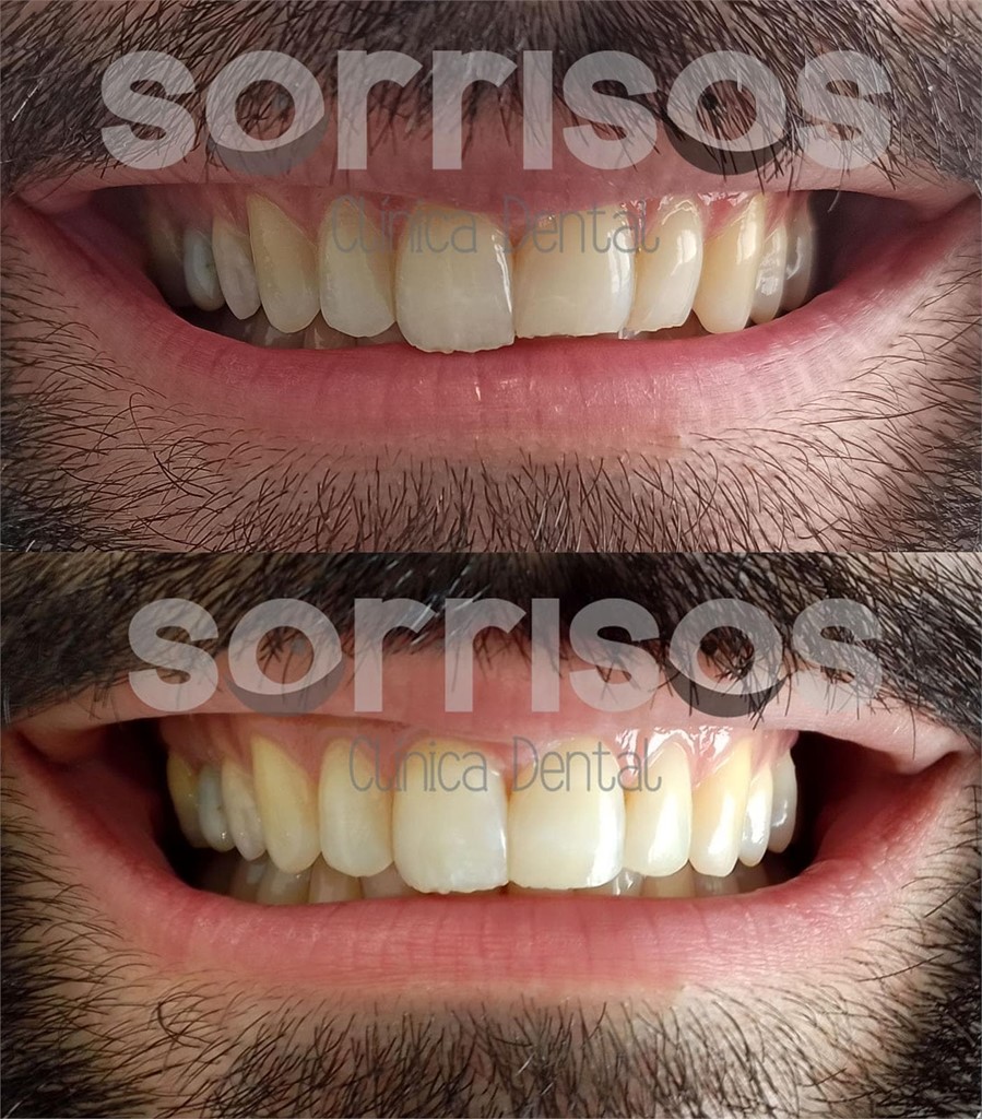 Restauración de bordes incisales mediante carillas directas de composite. 