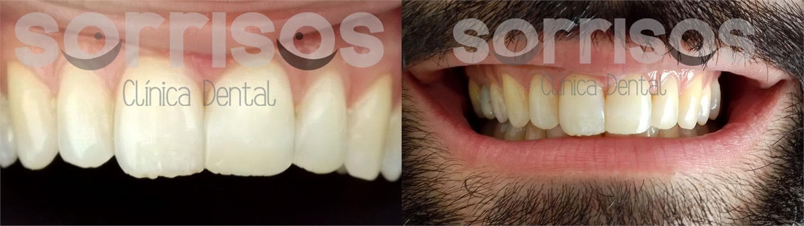 Restauración de bordes incisales mediante carillas directas de composite.  - Imagen 4